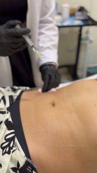 mesoterapia abdomen