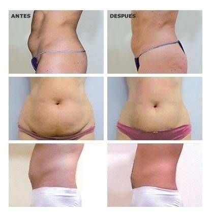 mesoterapia abdomen