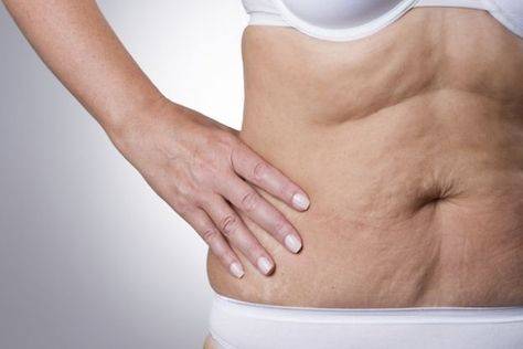 mesoterapia abdomen