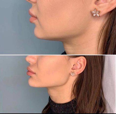 mesotherapy before and after