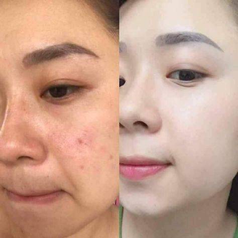 mesotherapy before and after