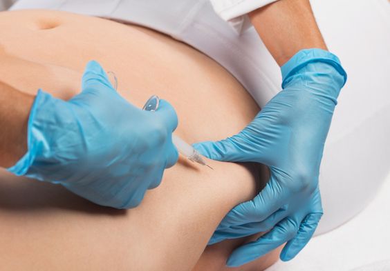 Mesotherapy fat dissolving injections