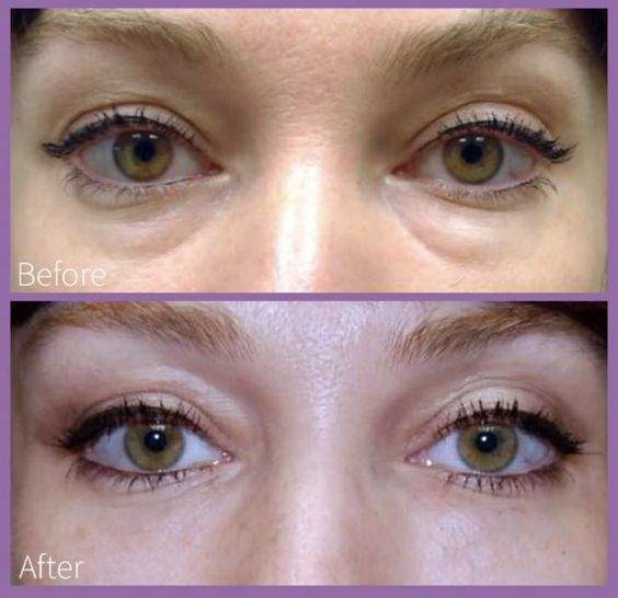 Mesotherapy Under Eyes: Before and After Results