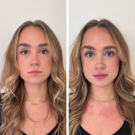 natural lip fillers before and after