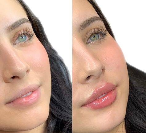 natural lip fillers before and after