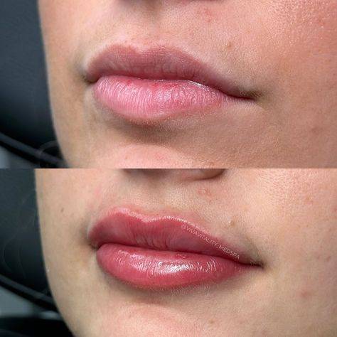 natural lip fillers before and after