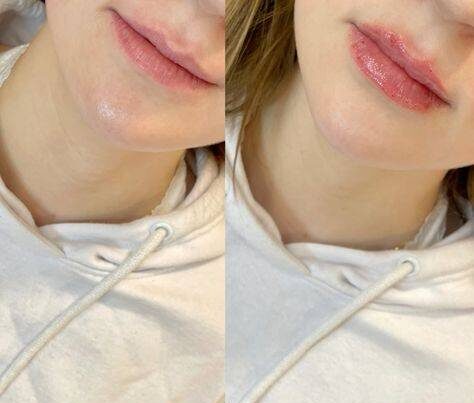 natural lip fillers before and after