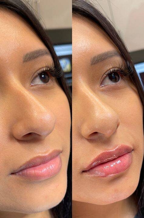 natural lip fillers before and after