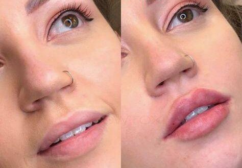 natural lip fillers before and after