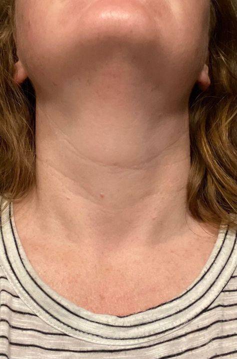 Neck wrinkles before and after