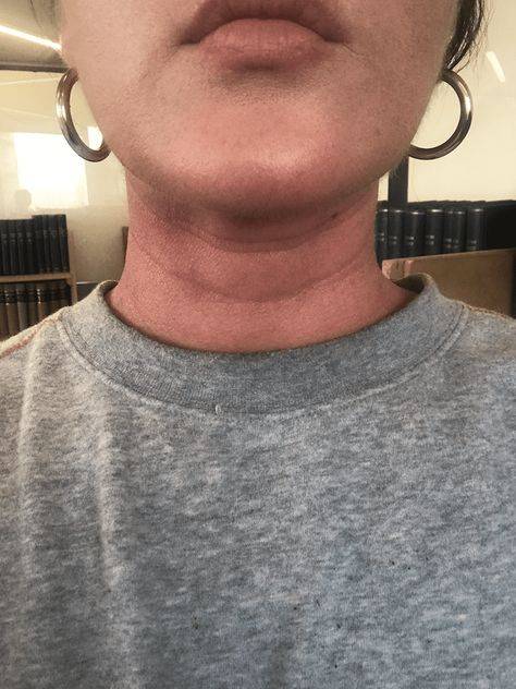 Neck wrinkles before and after