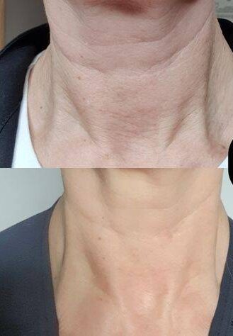 Neck wrinkles before and after