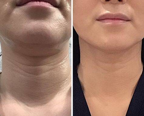 Neck wrinkles before and after