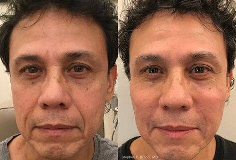 non surgical facelift