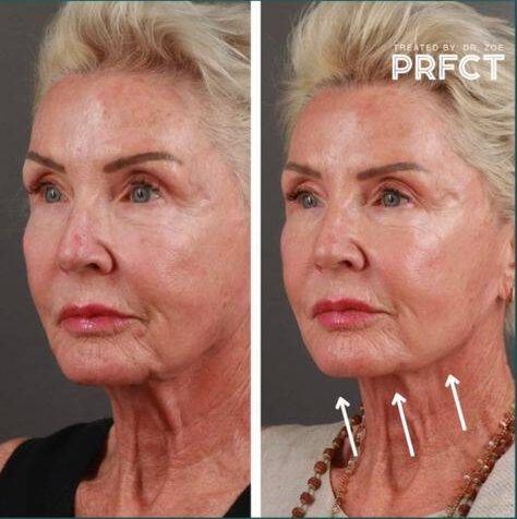 non surgical facelift