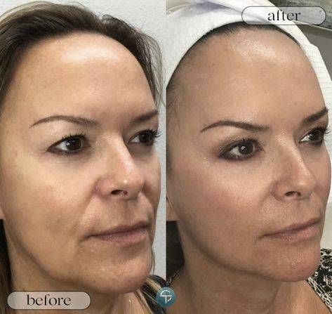 non surgical facelift