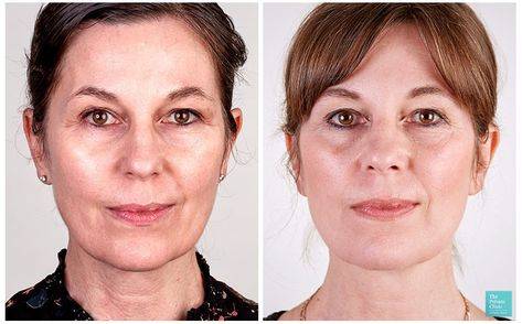 non surgical facelift