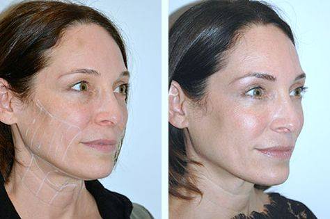 non surgical facelift