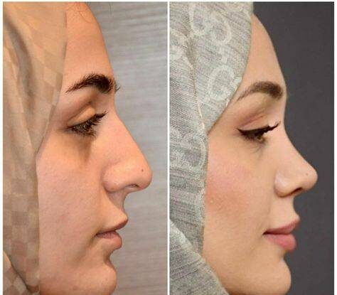 nose botox