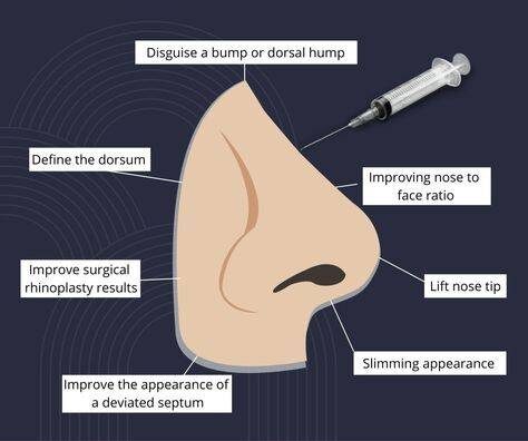 nose botox