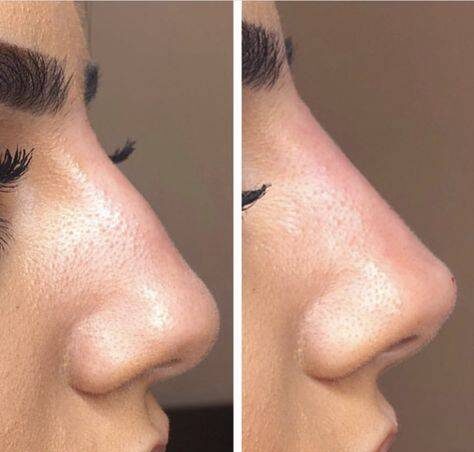 nose botox