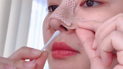 nose care after rhinoplasty