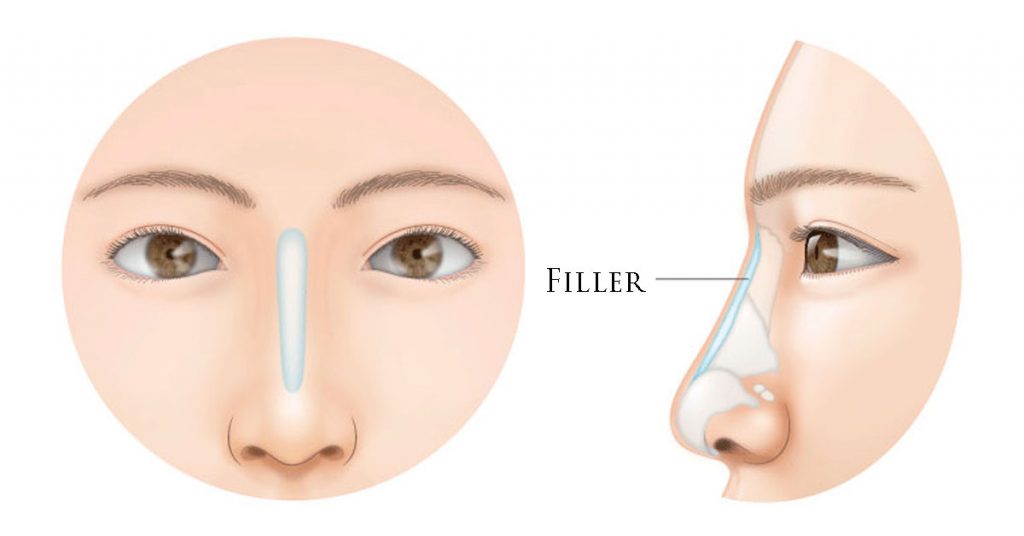 Nose Fillers