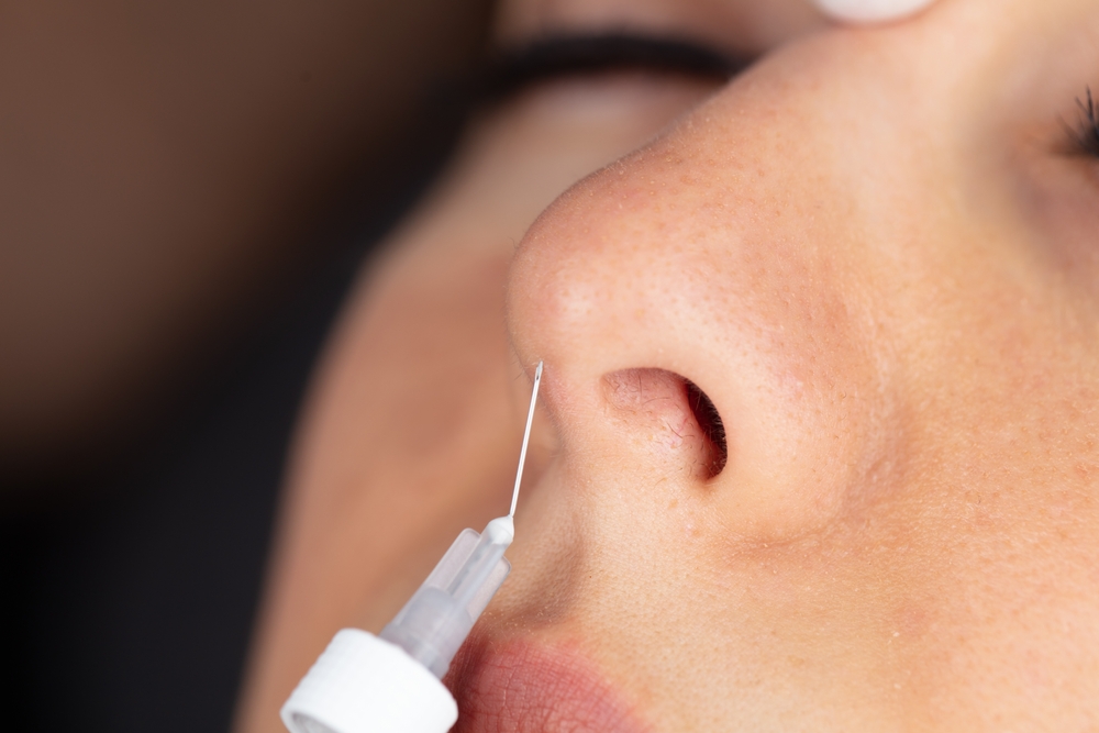 Nose Thread Lift