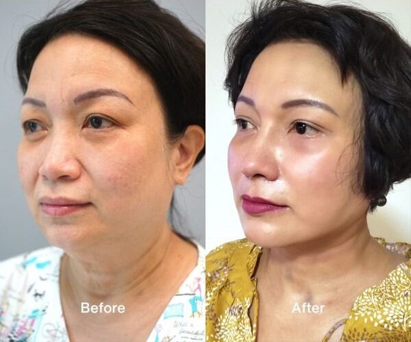 nose thread lift before and after asian