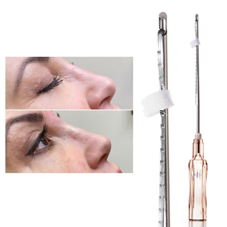 Nose Tip Nose Thread Lift