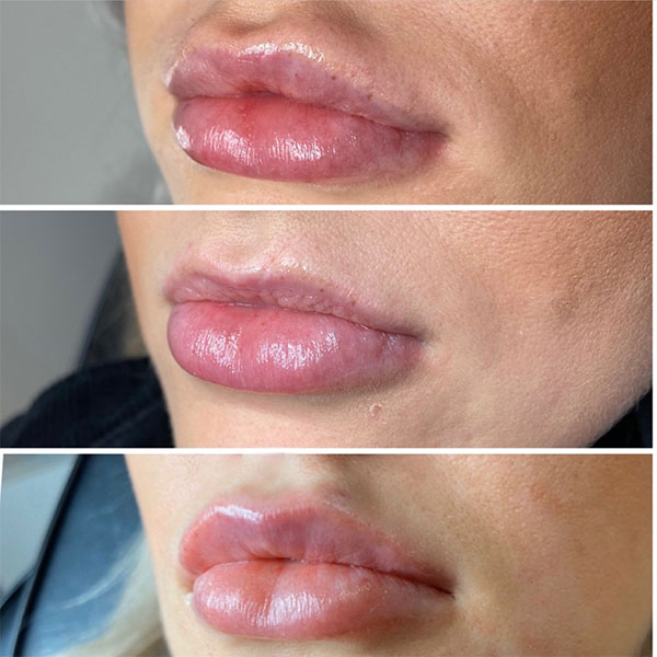 Overfilled Lip Borders