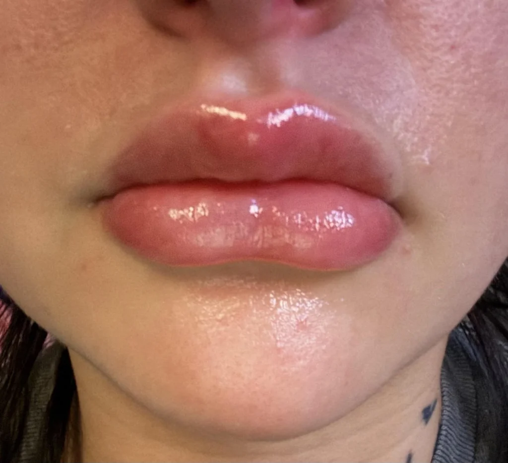 Overfilled Lips