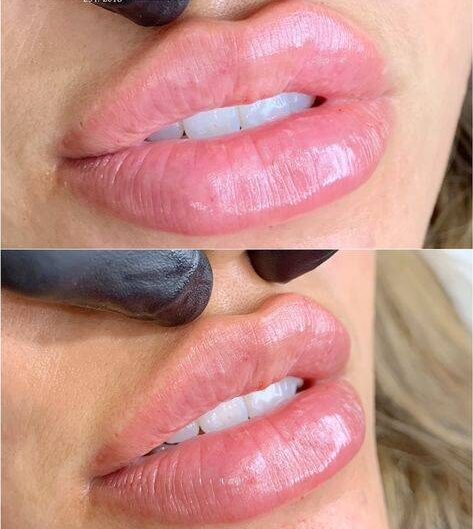 overfilling lips