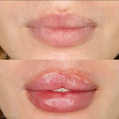 overfilling lips