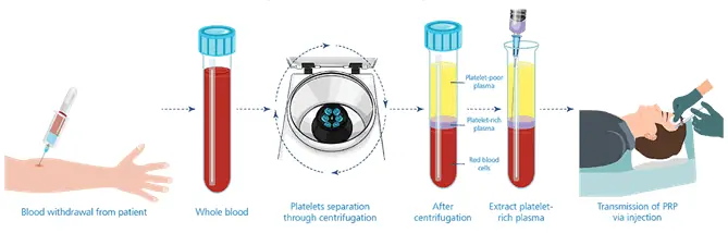 platelet-rich-plasma-prp