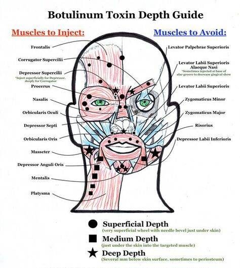 preventative botox