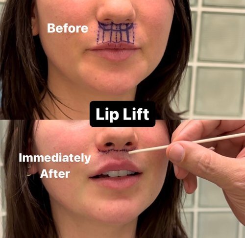 Real Lip Flip Surgery Before and After Case