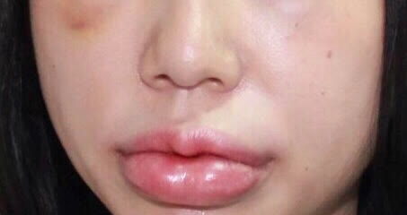 Redness and swelling after filler injection