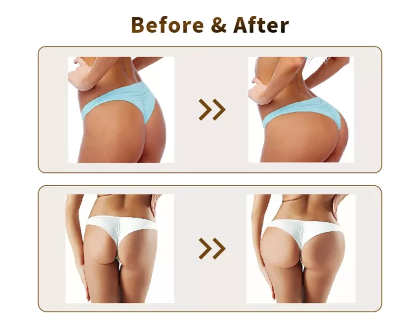 Results after hyaluronic acid filler injection for buttocks