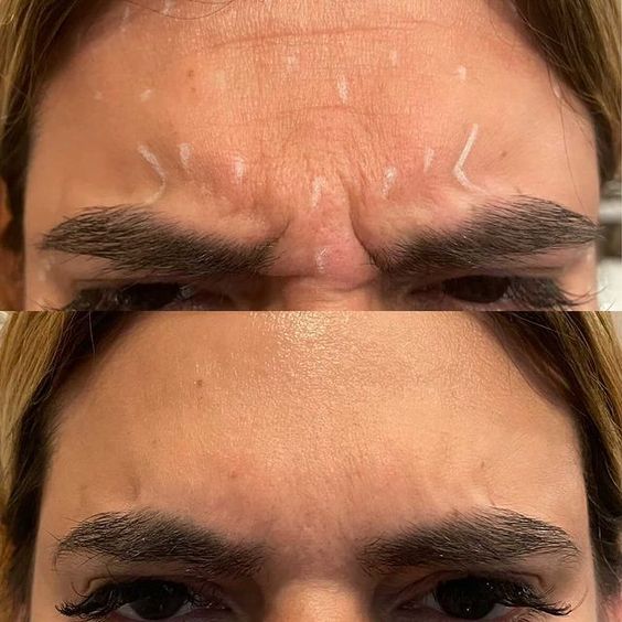 Results and Longevity of the 8 Point Filler Facelift