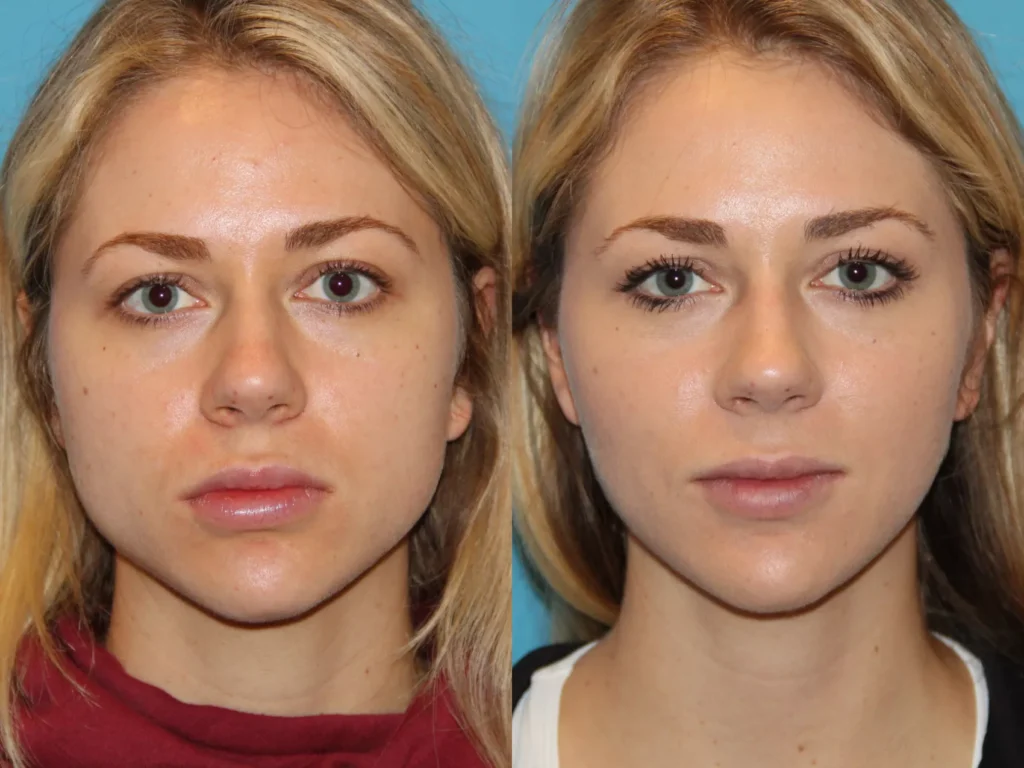 Results from jaw slimming Botox