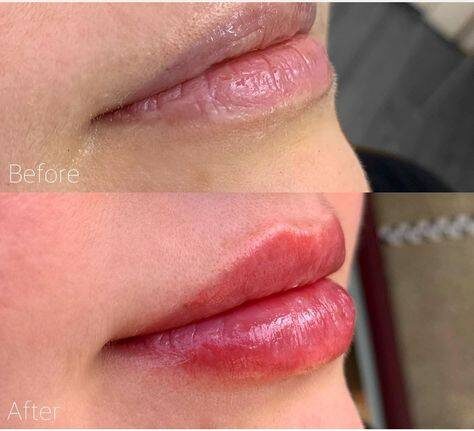 safest lip filler