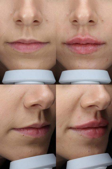 safest lip filler