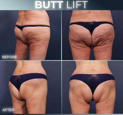 sagging buttocks before and after