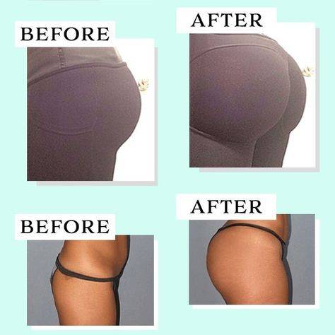 sagging buttocks before and after