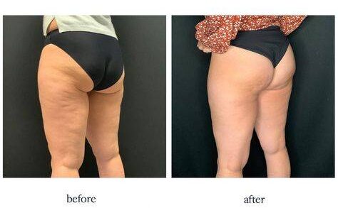 sagging buttocks before and after