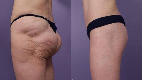 sagging buttocks before and after