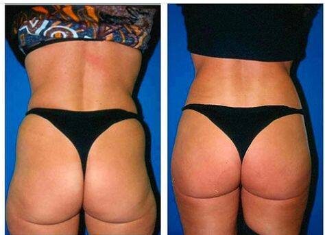 sagging buttocks before and after