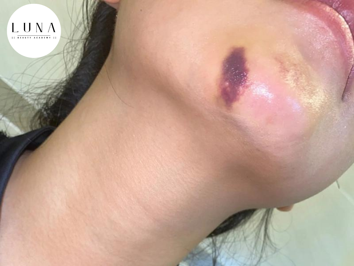 side effects of chin bruising after filler injection