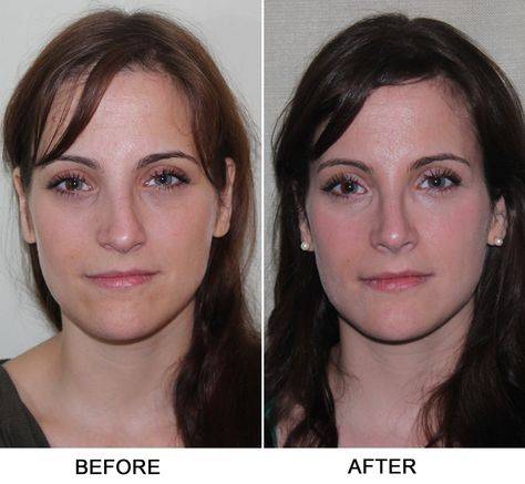 Smile eye surgery